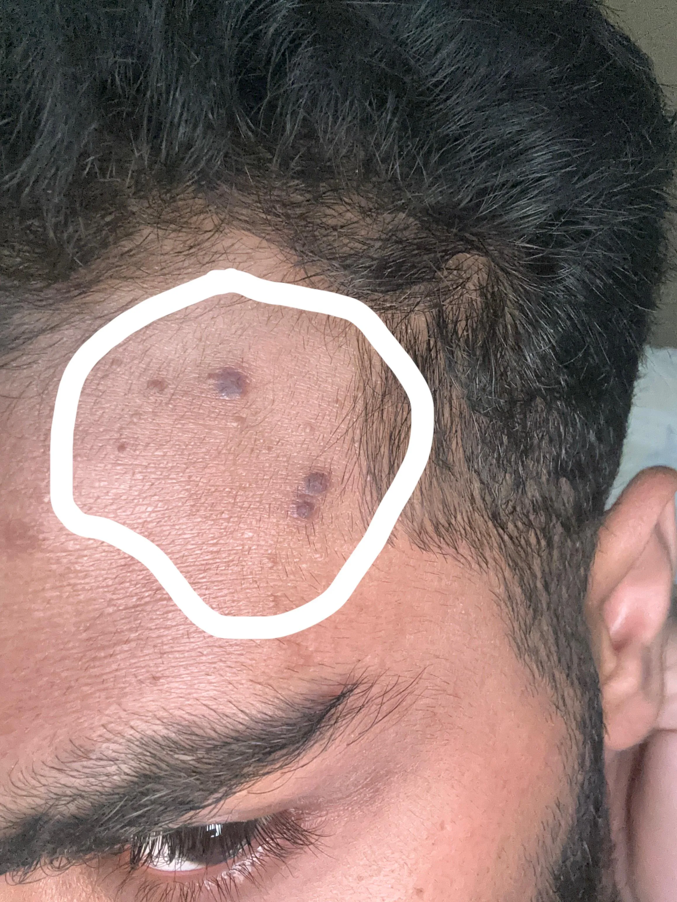 Thicked black post acne scars on Face after - Decription for more info