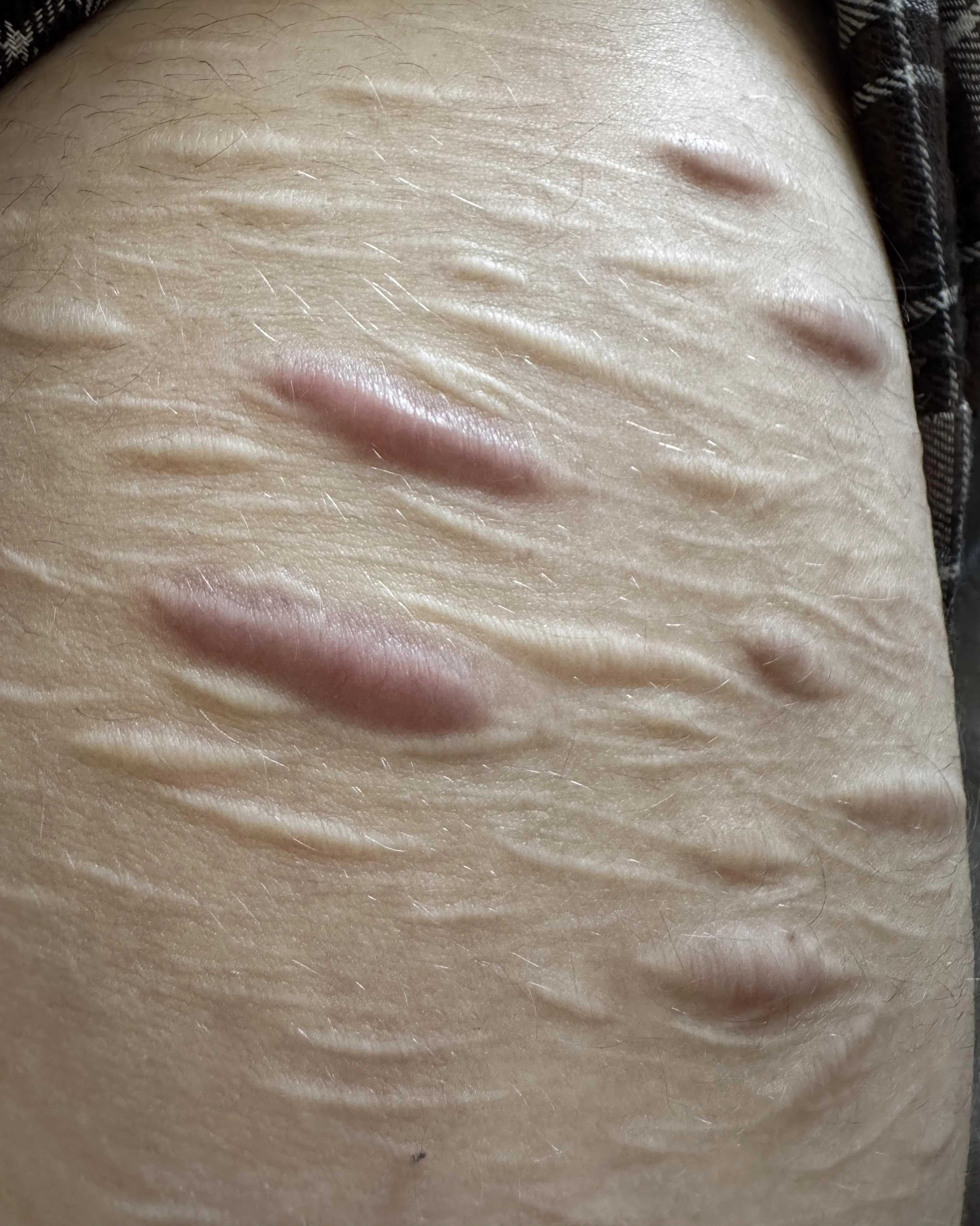 I’m 6 months clean and my scars are still pink