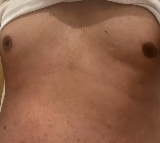 Damn in the process of loosing weight but have so many stretch marks…. But health is more important…