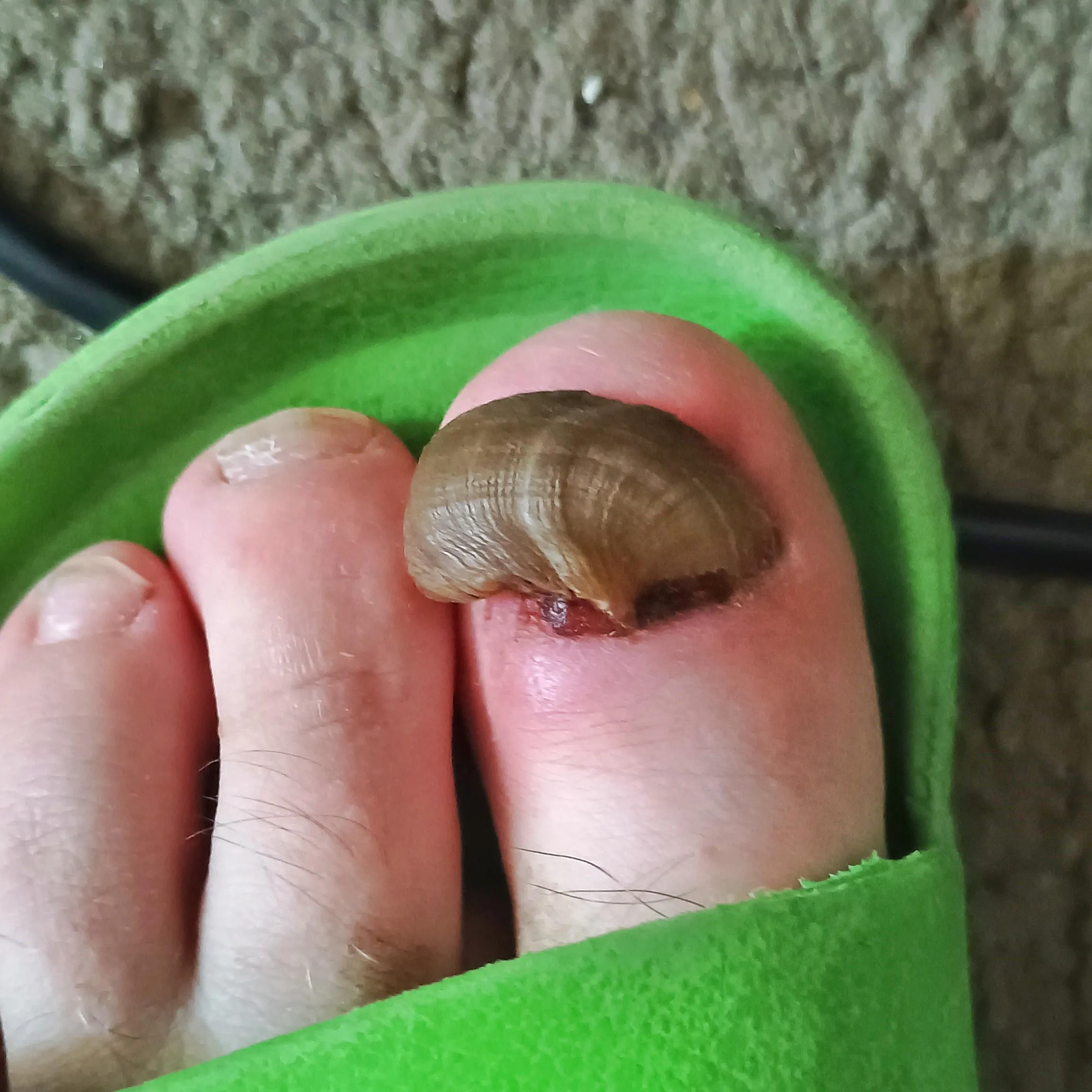 How my toe decided to grow back after it got removed.