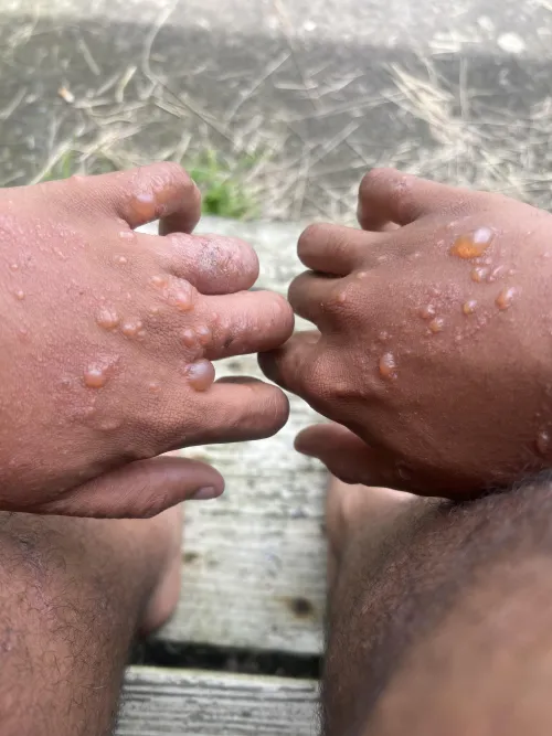 Recently found out about poison sumac.