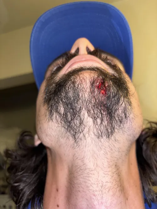 Does my husband need stitches? He says no, but I’m not sure. Hasn’t bled too much but hasn’t stopped bleeding since the accident 2-3 hours ago.