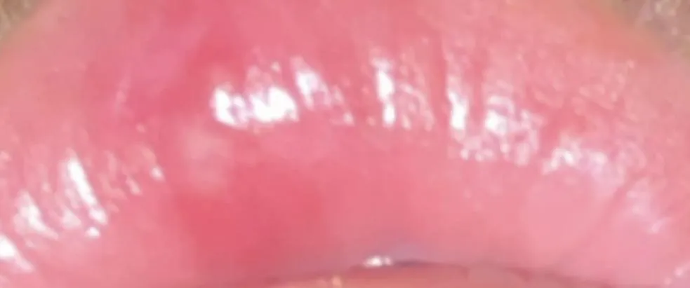 What is on my lip. Blister like wound only one location on lip. Painful. Showed up in one day. Not like normal cold sores I get.