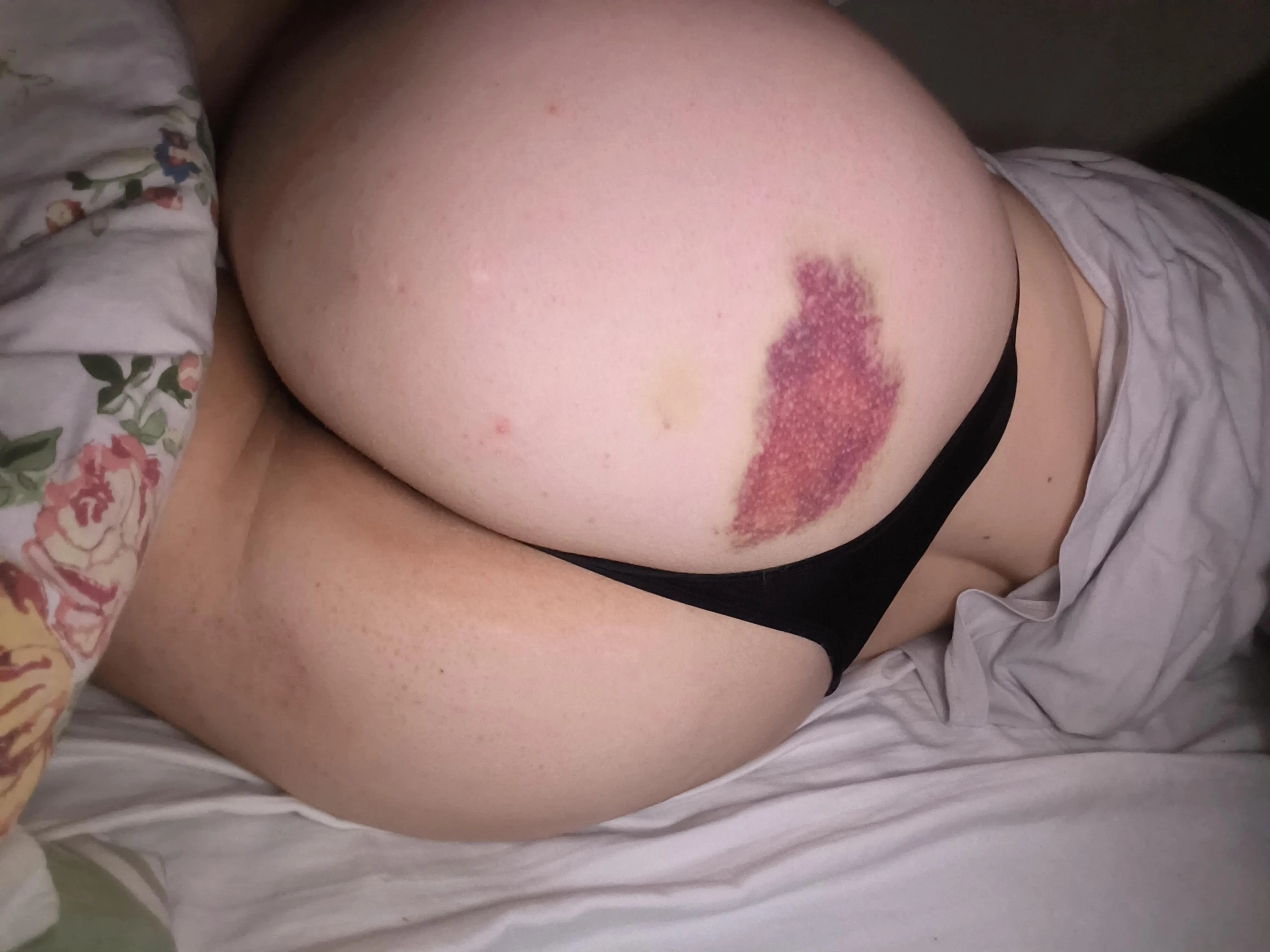 A week old bruise :)