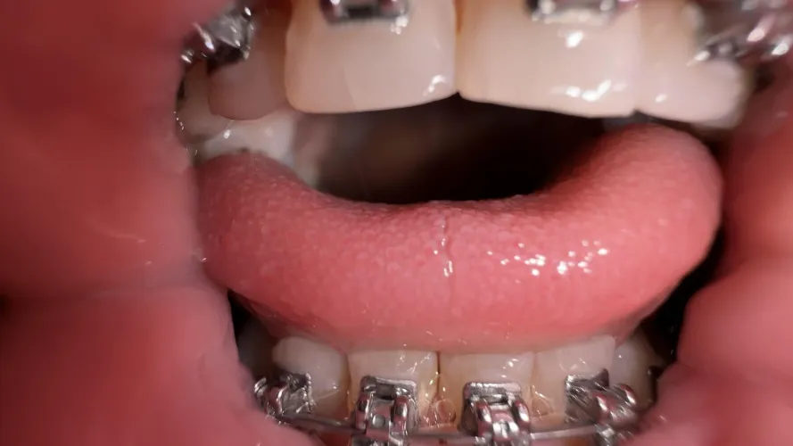Extra close-up of my new braces... and my mouth is already wet for you