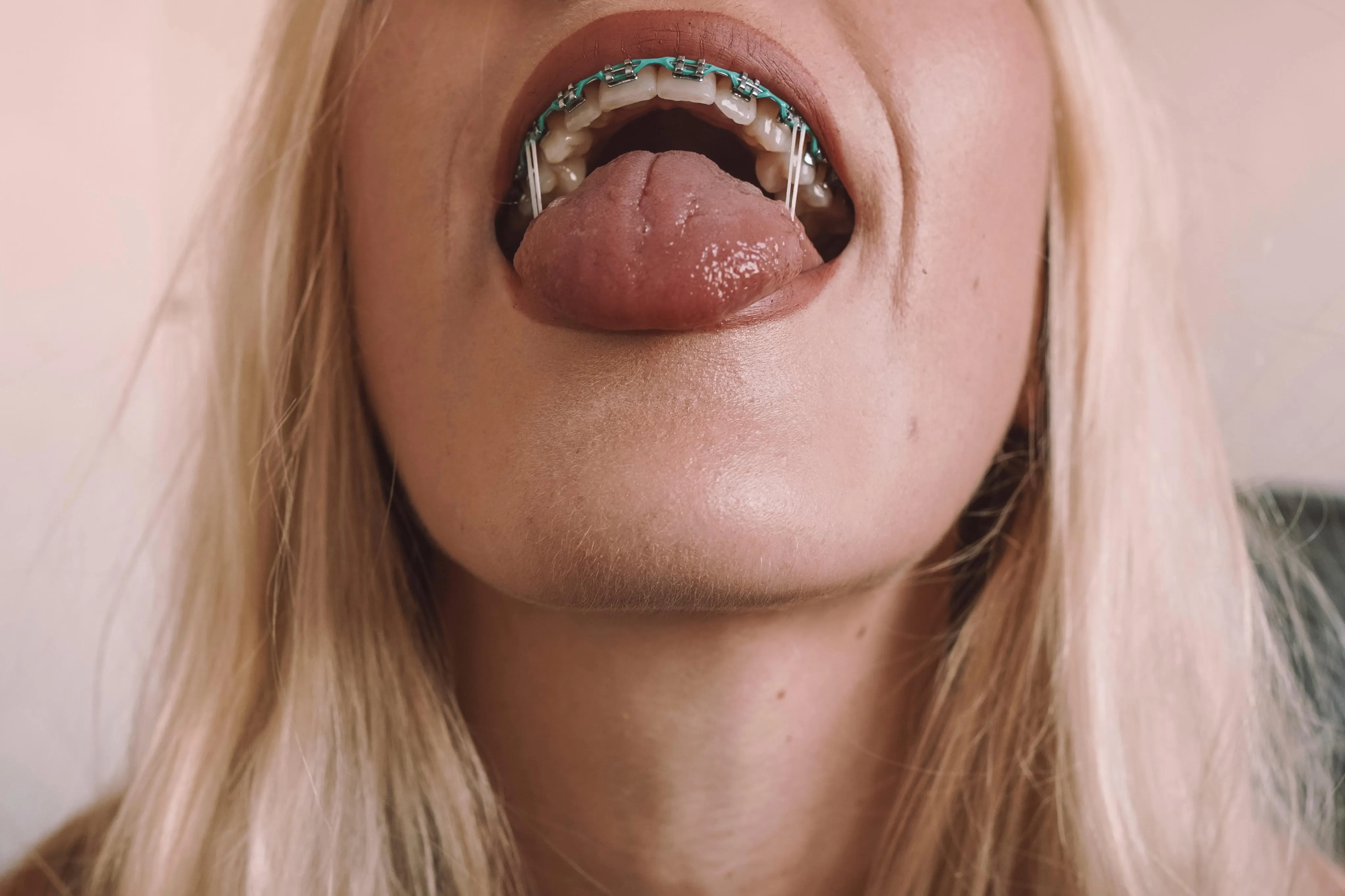 This was my all-time favorite braces color