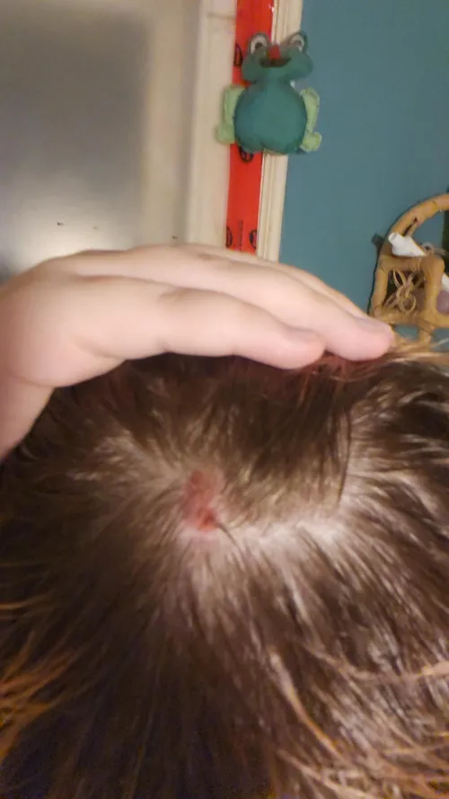 My scalp because i compulsively pick it, this is from a few days ago but i cant get a better pic