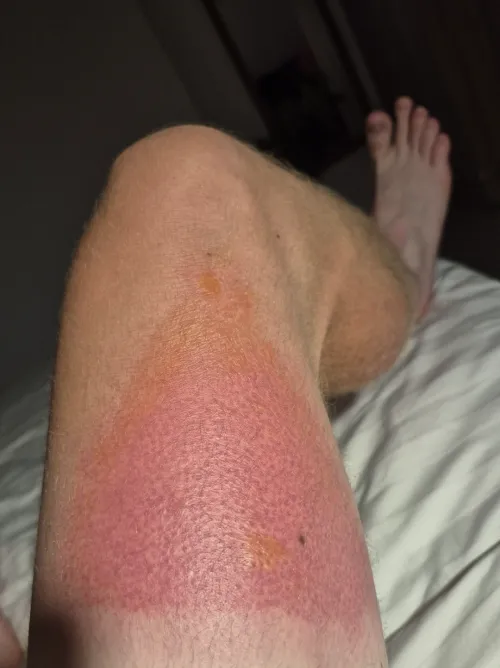 Nasty sunburn