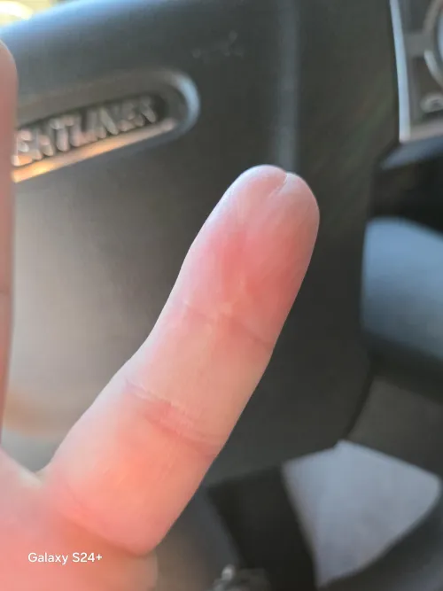 Here is my scarred finger update after about 23 years