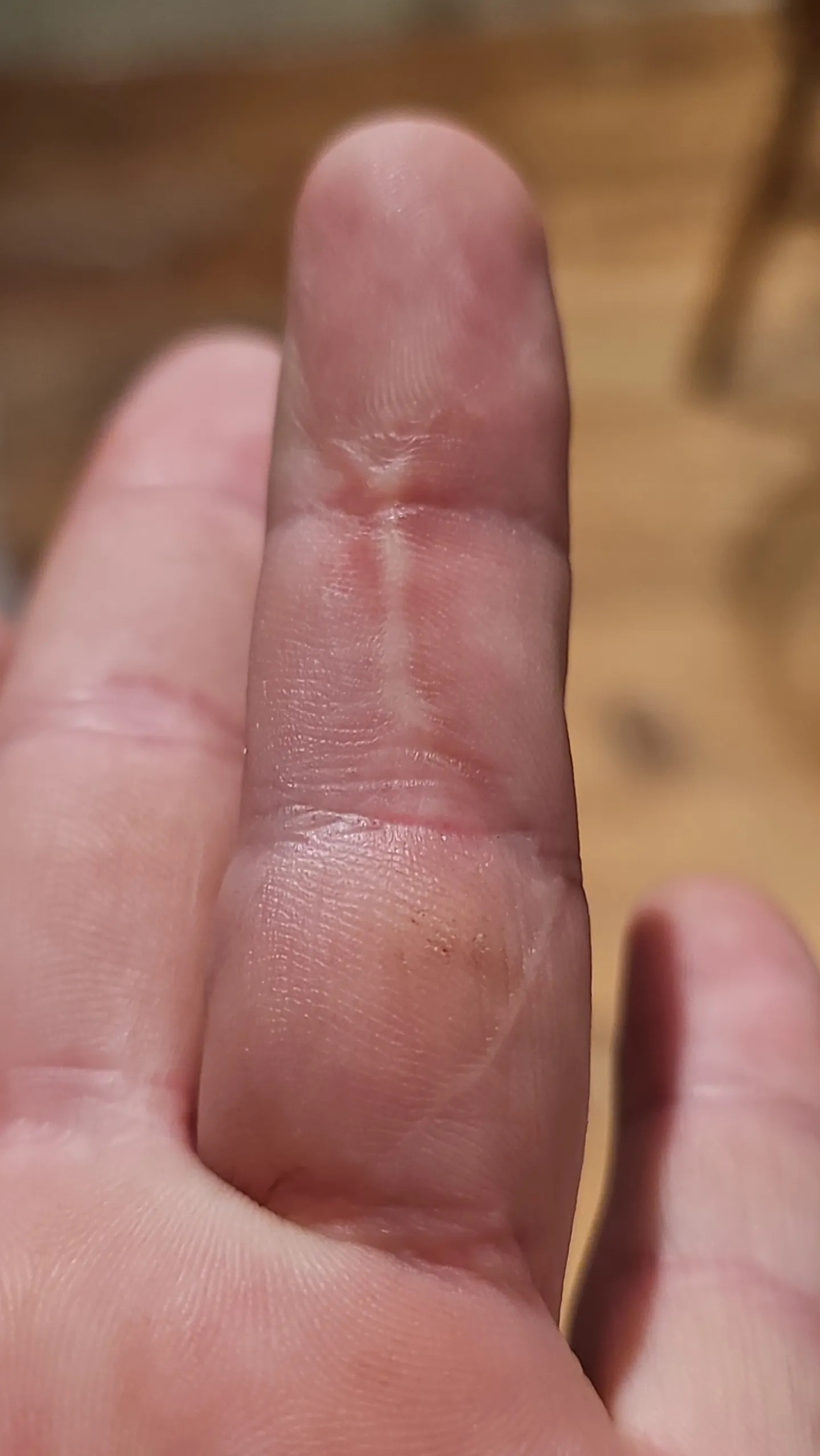 I posted the stitches a while ago, forgot that people wanted to see the scar, it's not that bad.