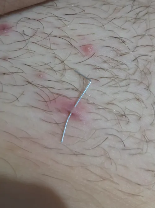 Was trying to dig out an in grown hair on my public bone area until...