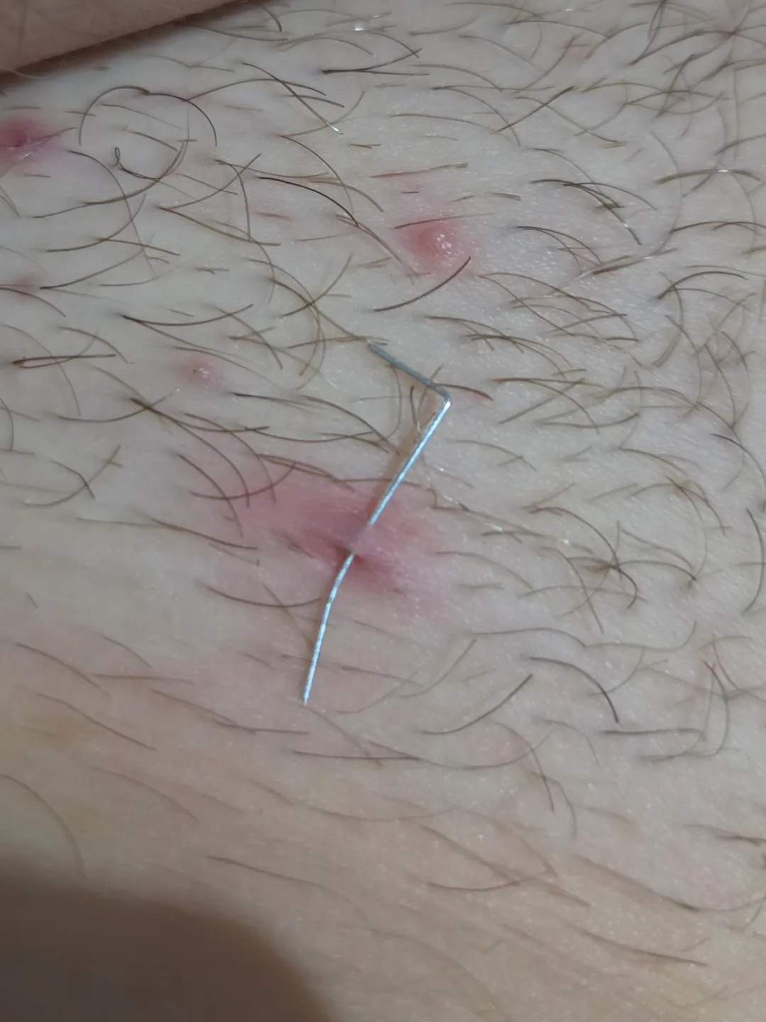 Was trying to dig out an in grown hair on my public bone area until...