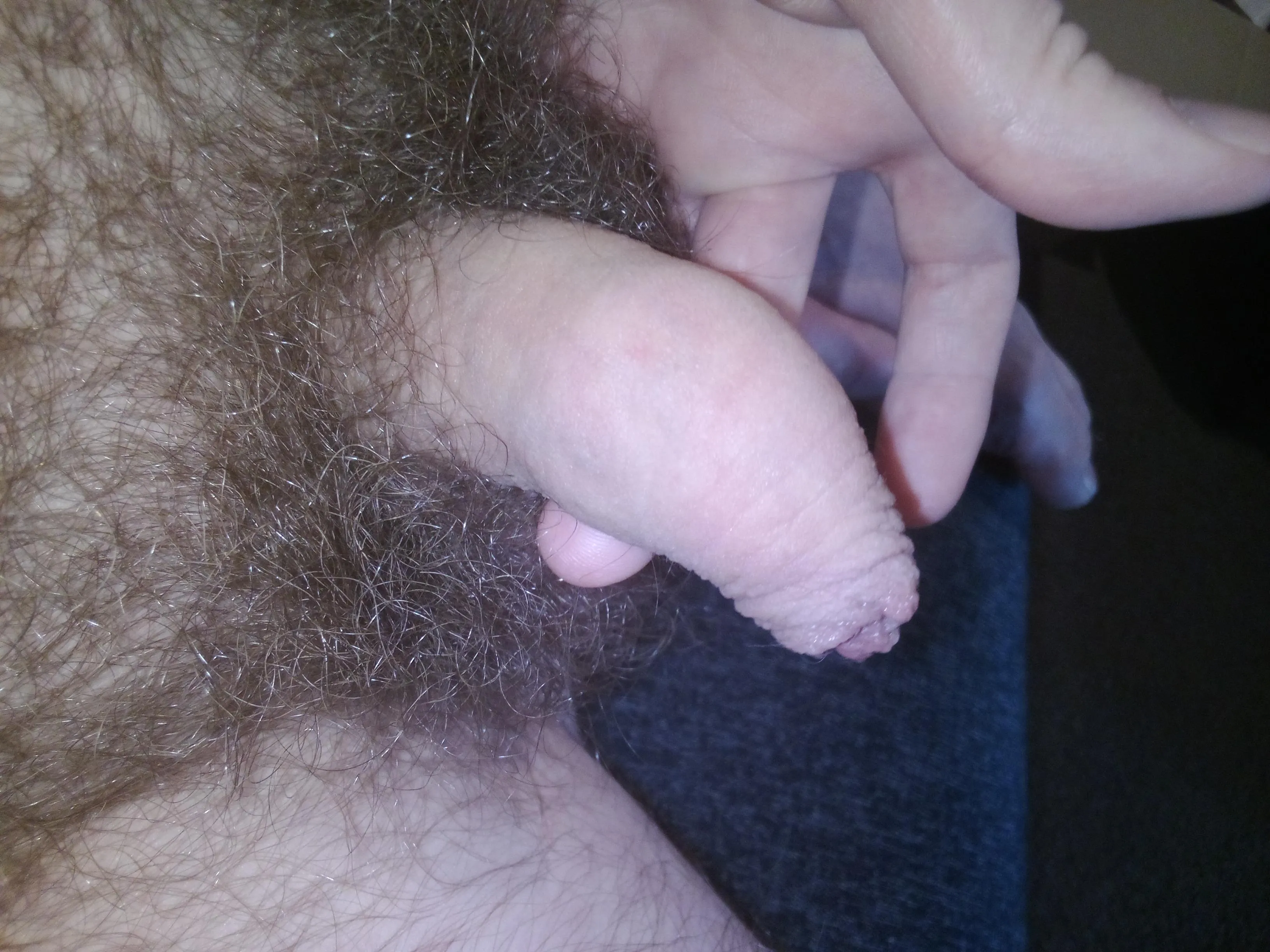 33 with mild phimosis keen to talk about phimosis