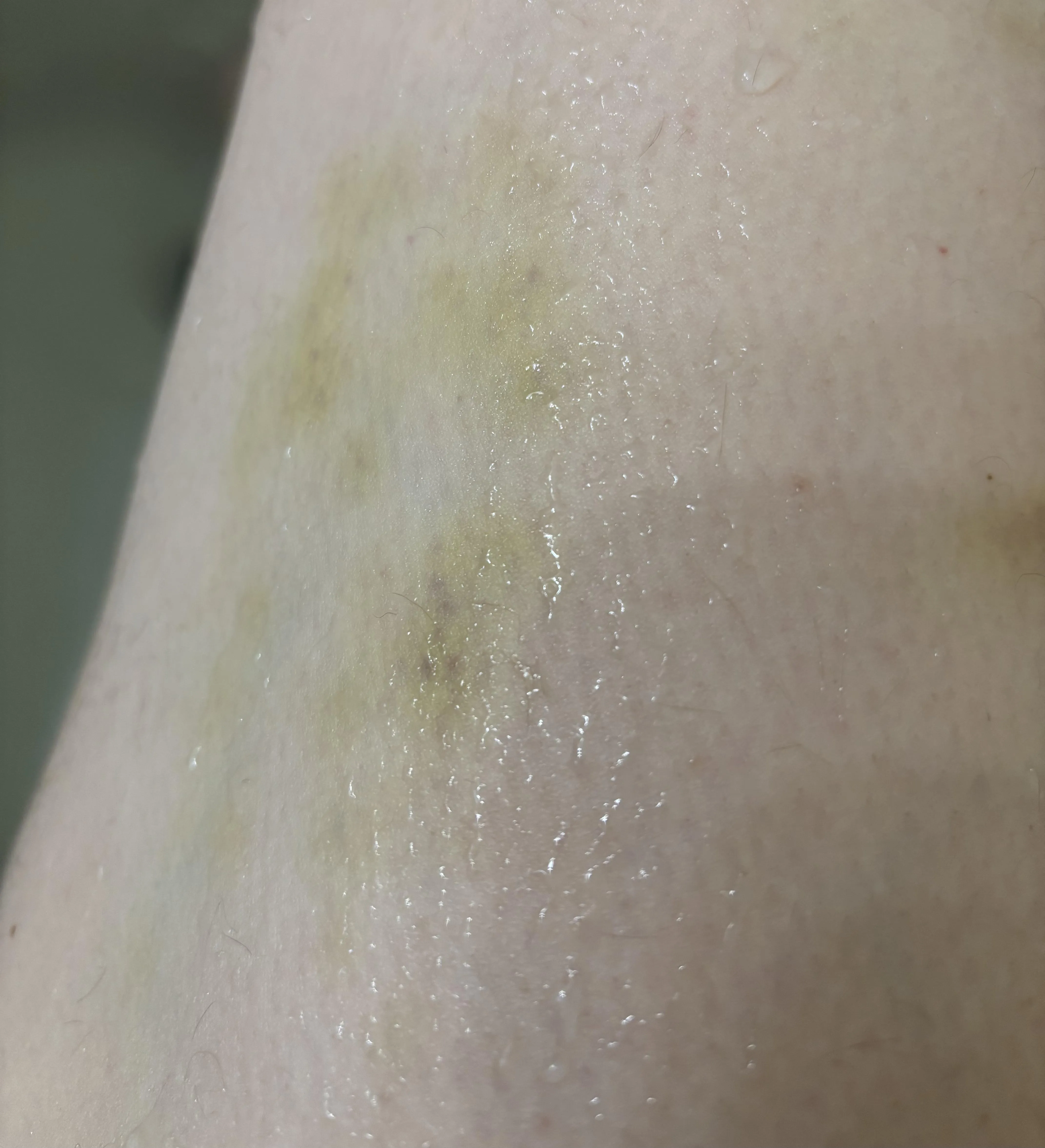 Bruising down my legs