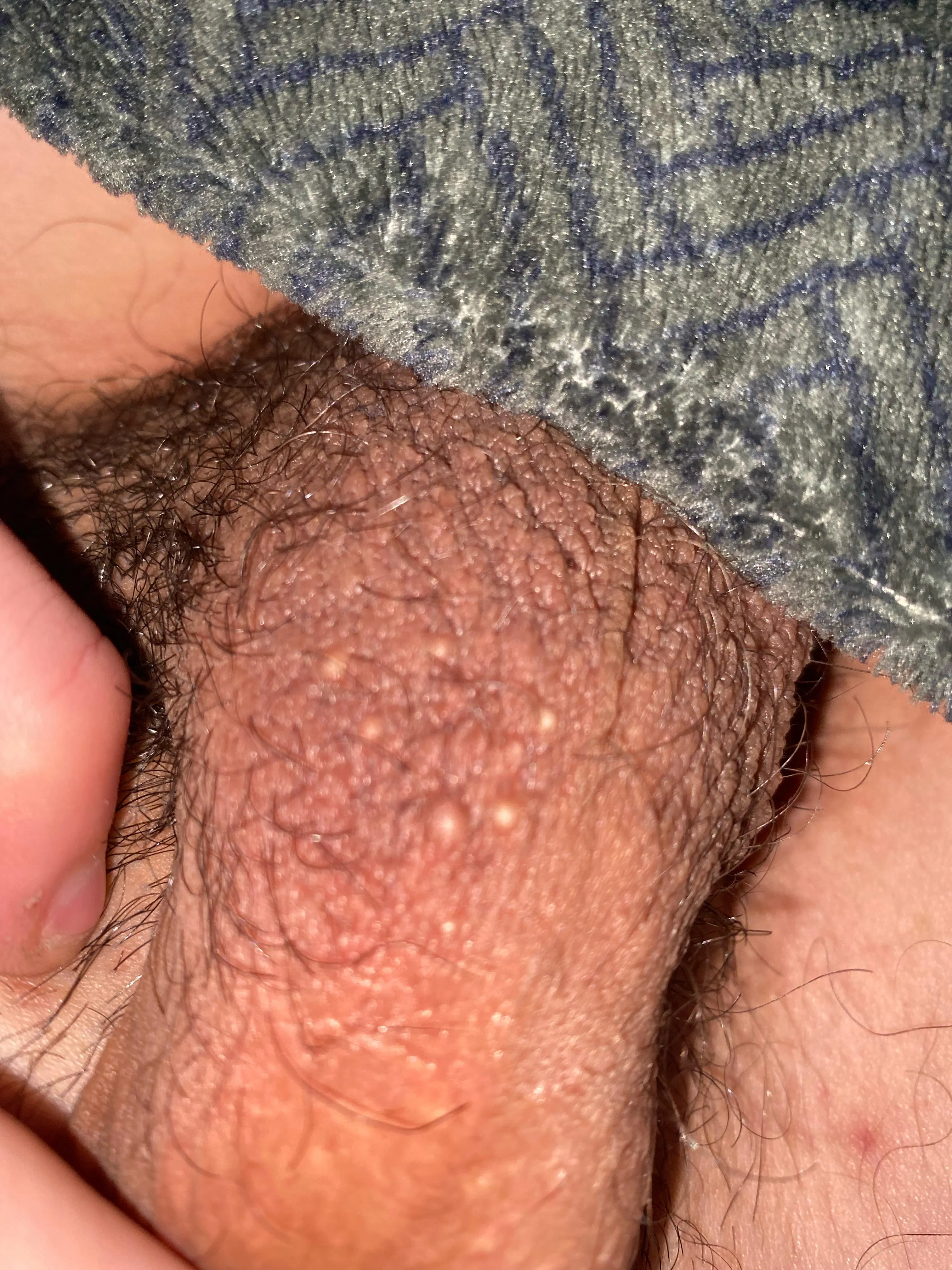 Sorry guys, but can anyone tell me what these are, they don’t hurt, they have been there for ages, and if I squeeze hard enough yellow stuff pushes out. Cheers