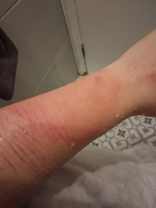 I've burnt my arm while intoxicated and making a hot water bottle