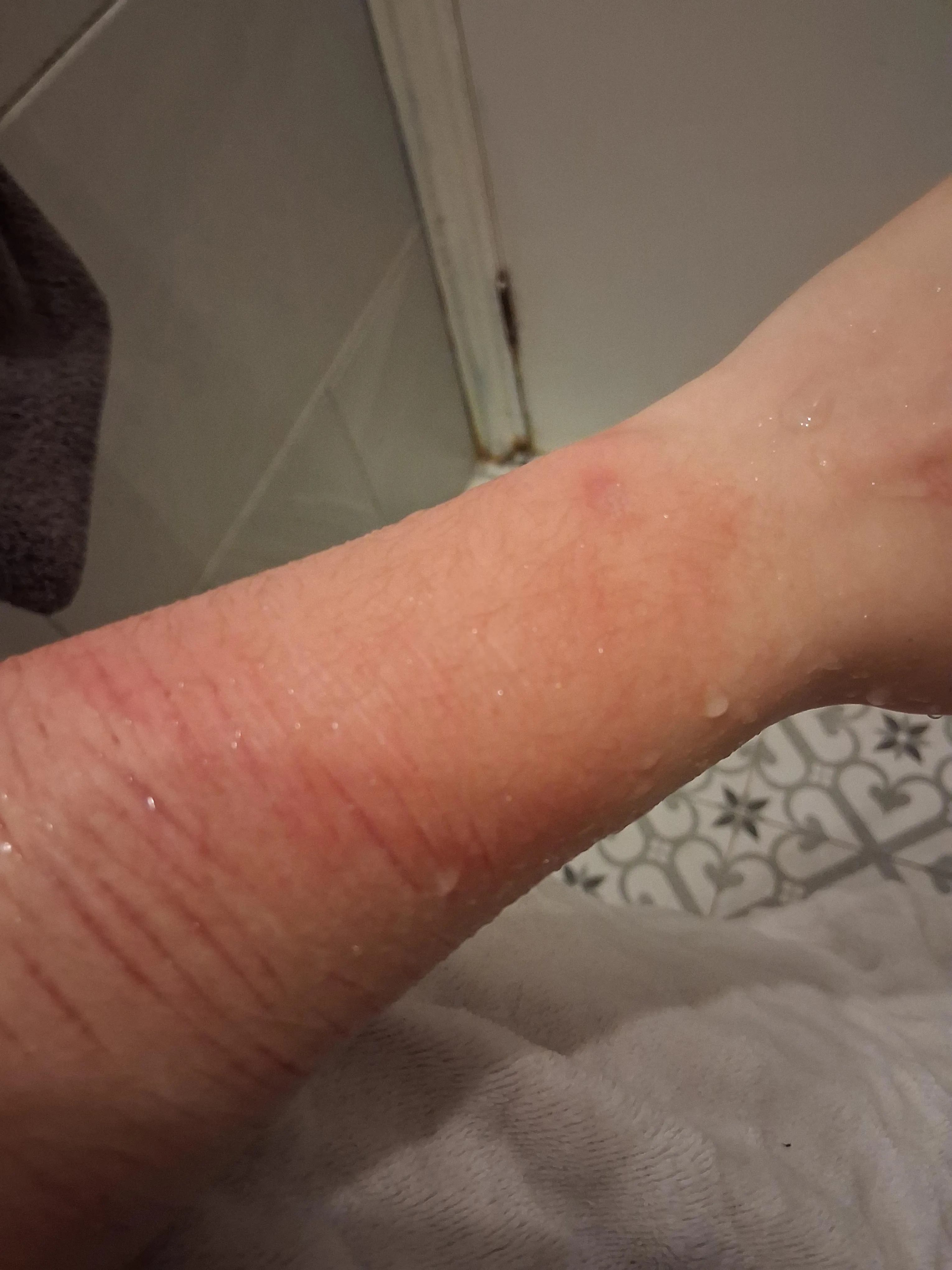 I've burnt my arm while intoxicated and making a hot water bottle