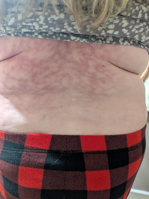 Really bad, weird, veiny looking rash-like thing on my lower half of my back. DOESN'T HURT.