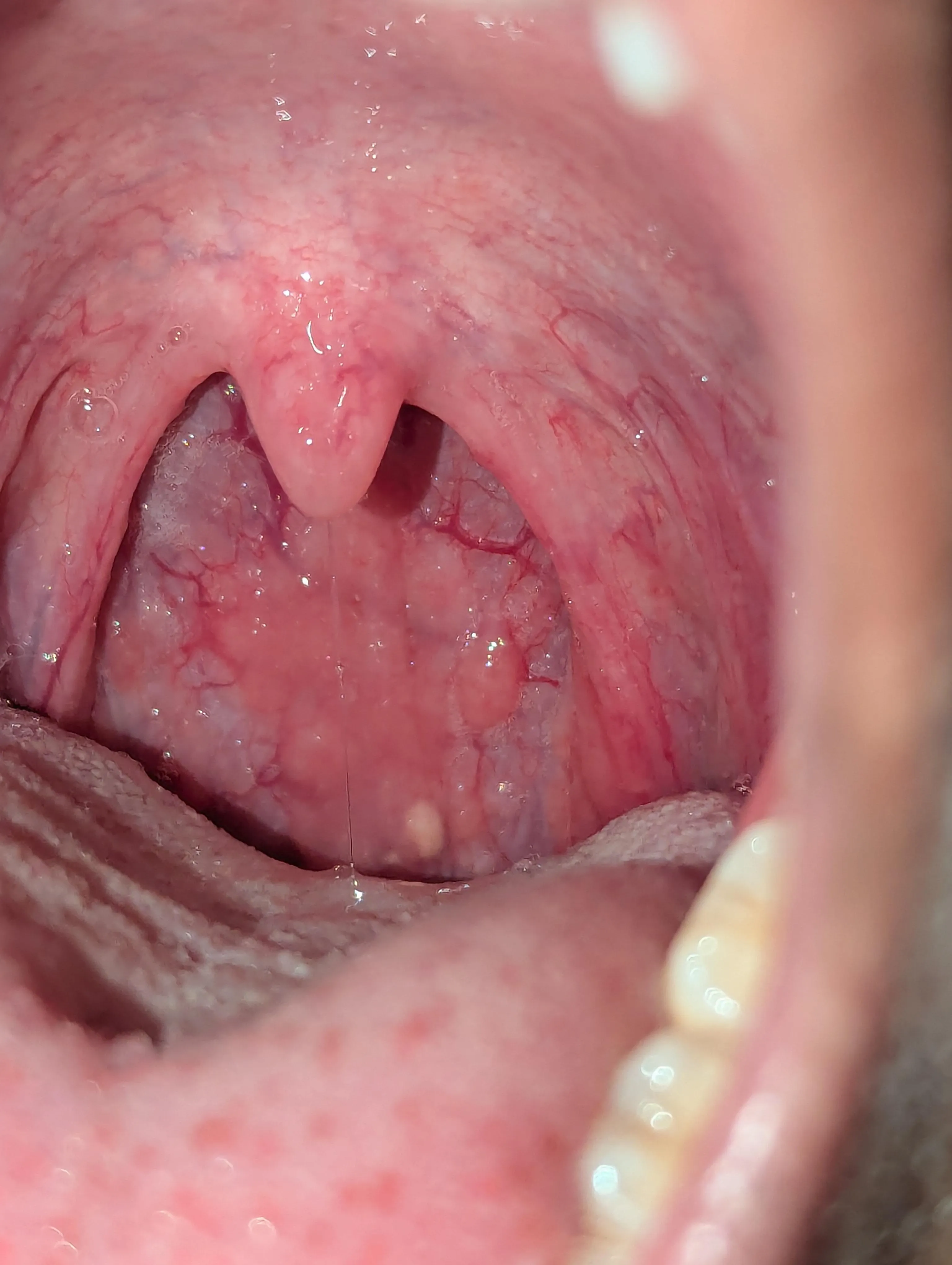 What type of throat infection is this? It's been like this for at least 3 months now