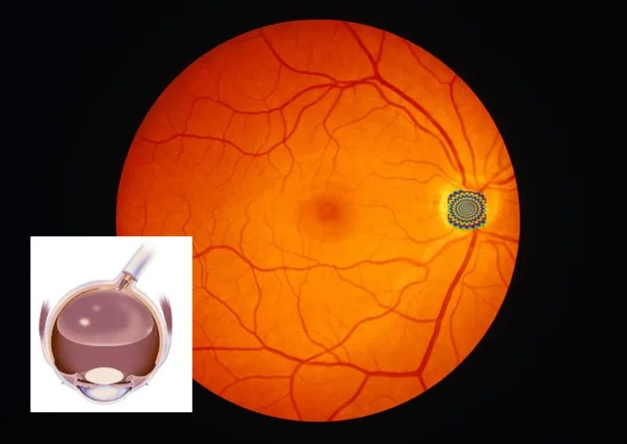 Seeing the kelidascope after eye sugery