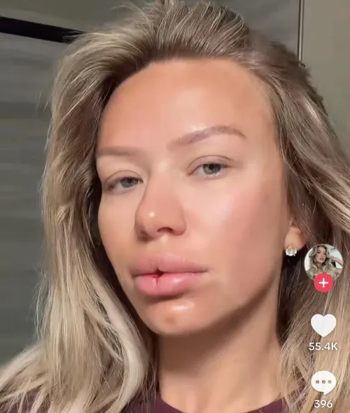 Looks like a wound in between her lips