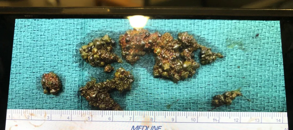 Gallbladder stones accumulated over the years