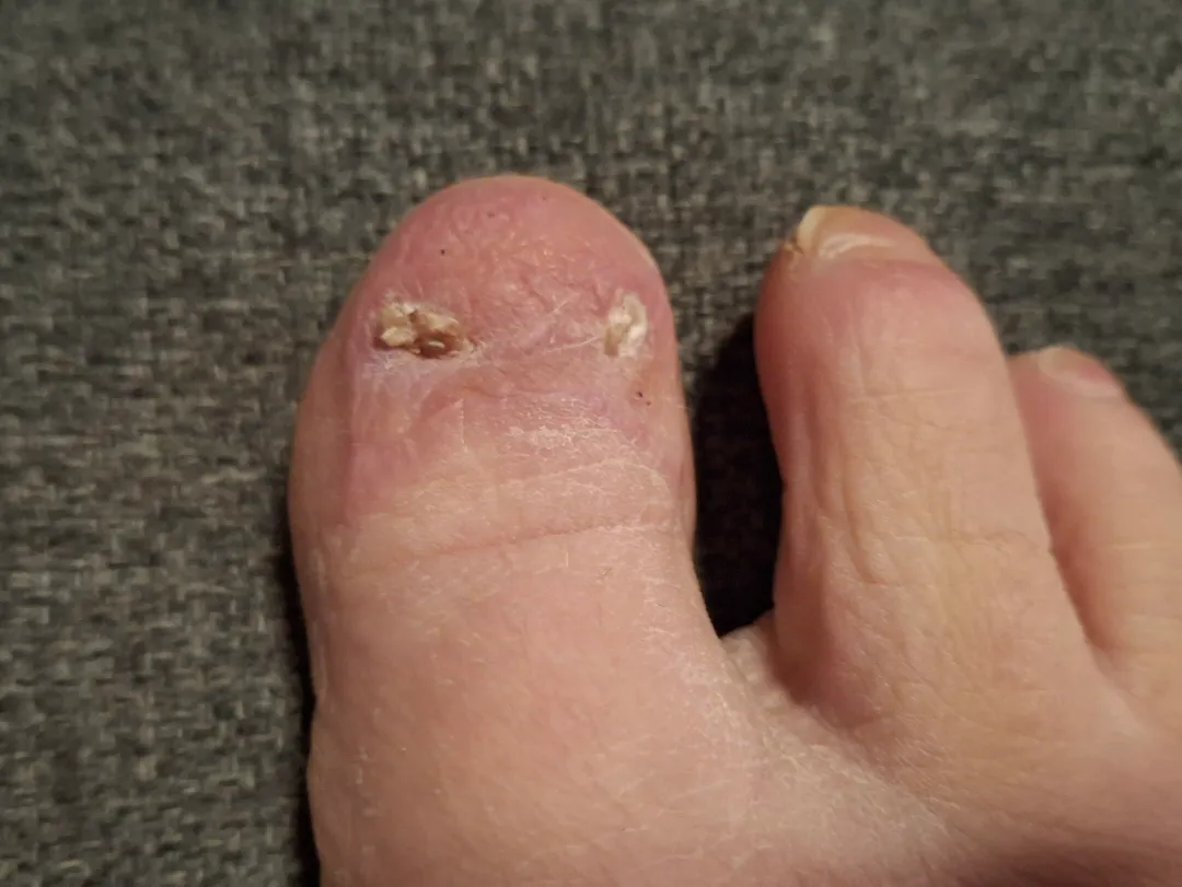 I had a nail melanoma removal and the skin transplant has fully healed