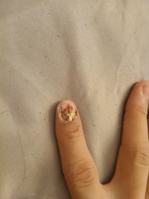 My infected fingernail