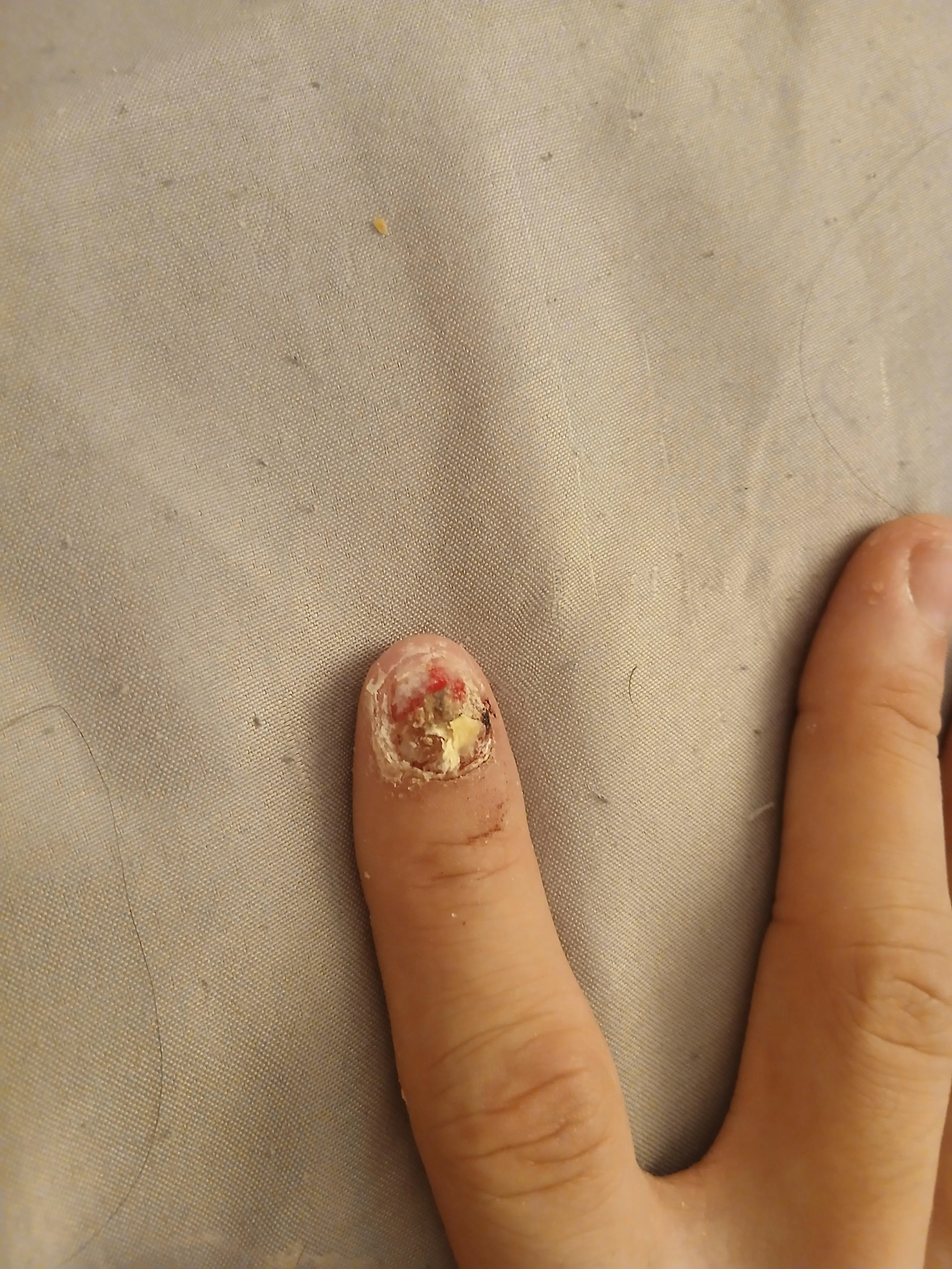 My infected fingernail
