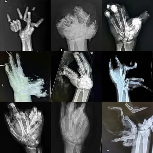 Xray of people's hand after fireworks injury