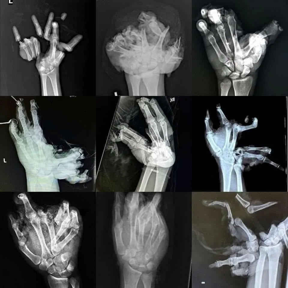 Xray of people's hand after fireworks injury