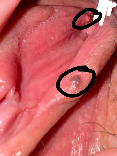 21F panicking about freckle and bump on my labia. Should I go to hospital? I can’t get in with an obgyn for 4 months