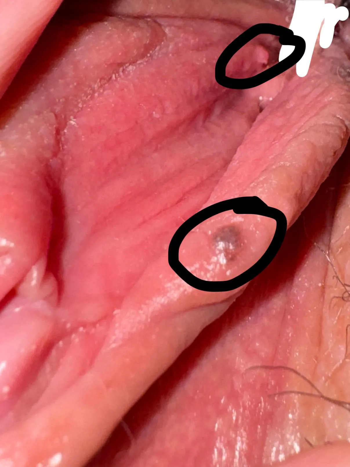 21F panicking about freckle and bump on my labia. Should I go to hospital? I can’t get in with an obgyn for 4 months