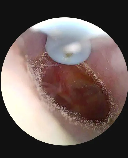 Need help identifying what this is in my ear, possible fungus, or spores of some kind?