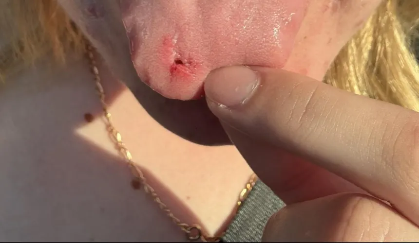 Bit a chunk out of my tongue swimming