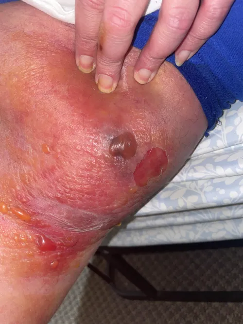 Flesh eating bacteria on my dads thigh