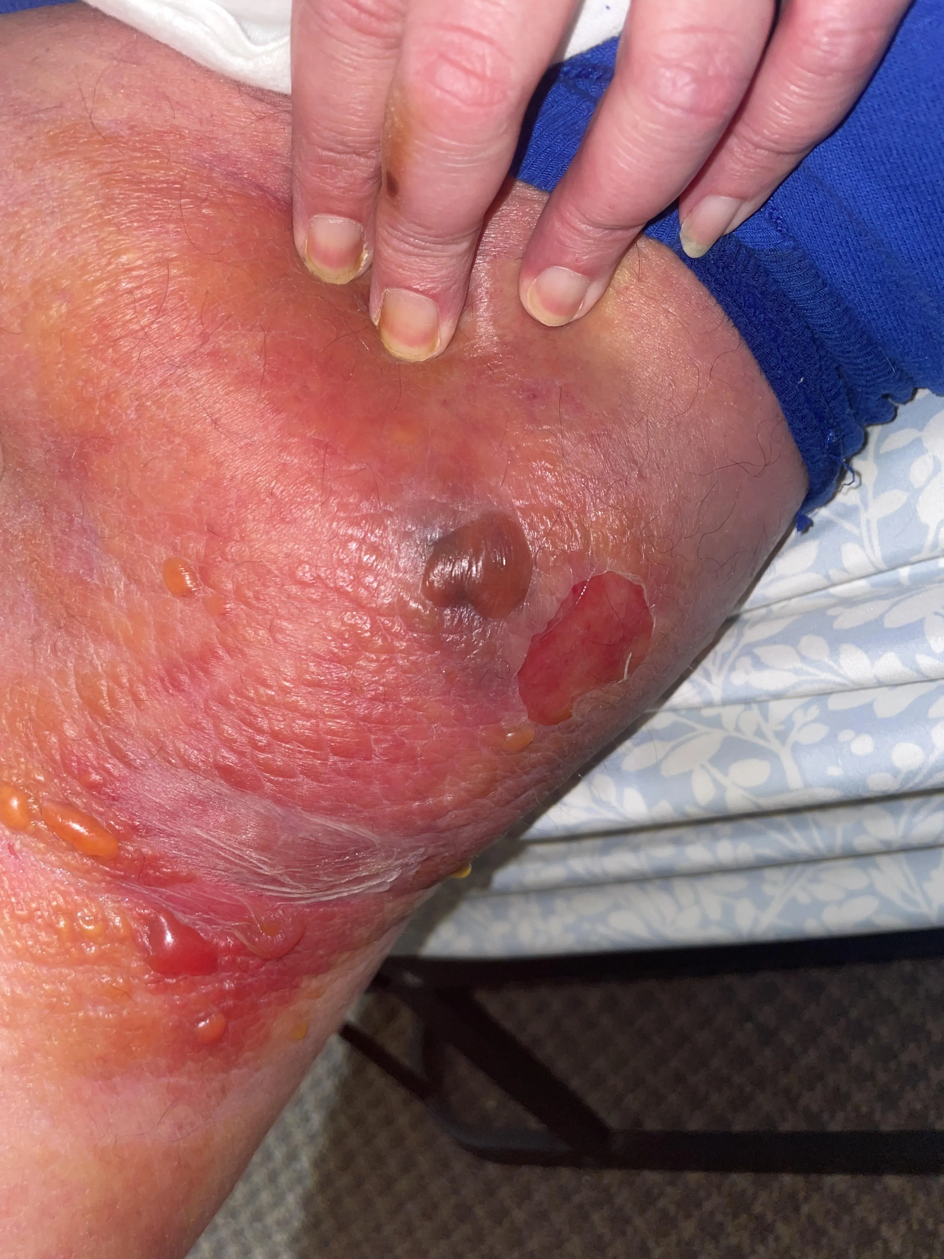 Flesh eating bacteria on my dads thigh