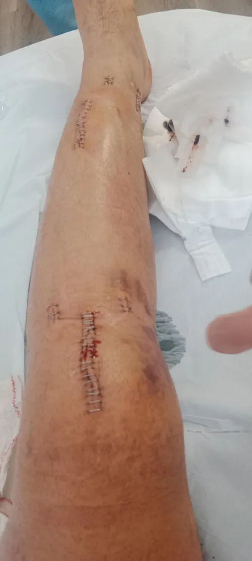 How a non-union tibia operation results in