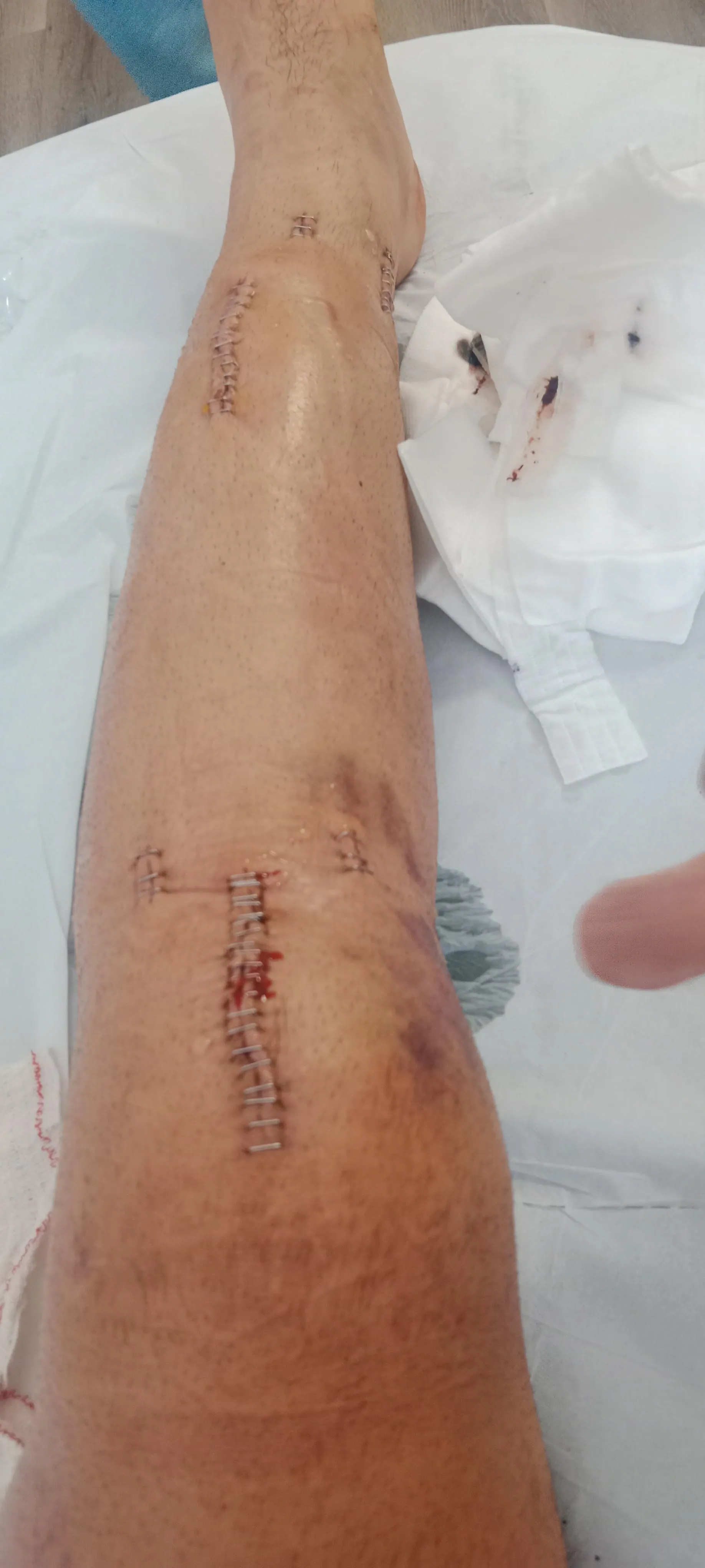 How a non-union tibia operation results in