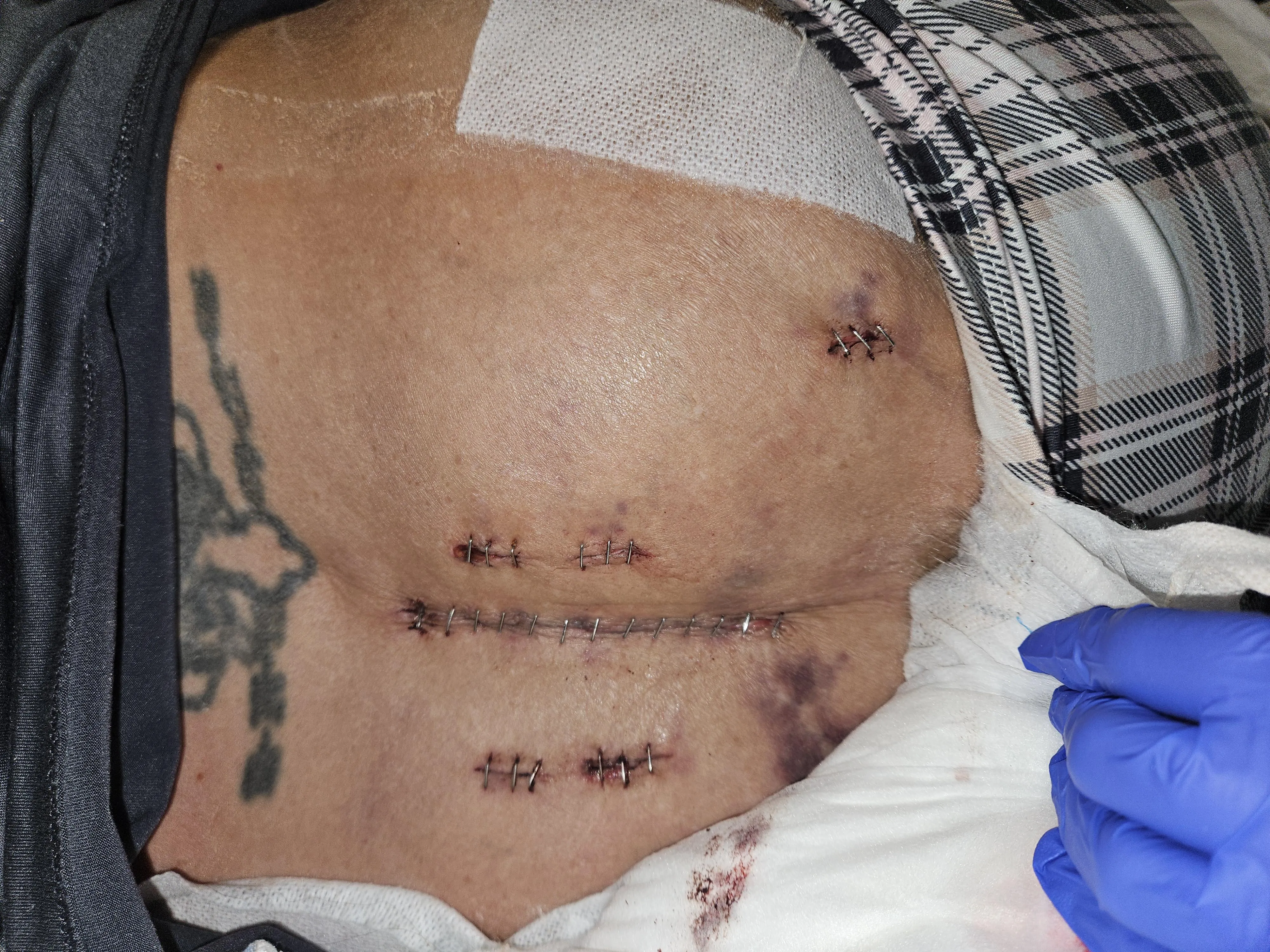 L4 & L5 fusion plus a couple extra procedures. Shaving bone and scraping joints