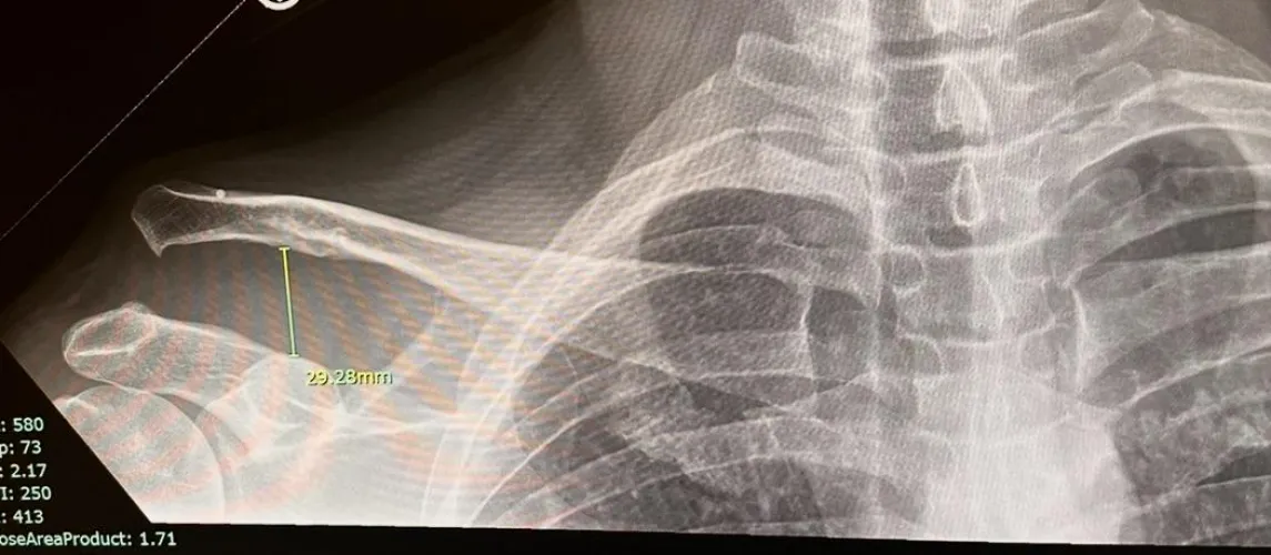 softball - Torn AC Joint, Torn Rotator Cuff, cracked scapula