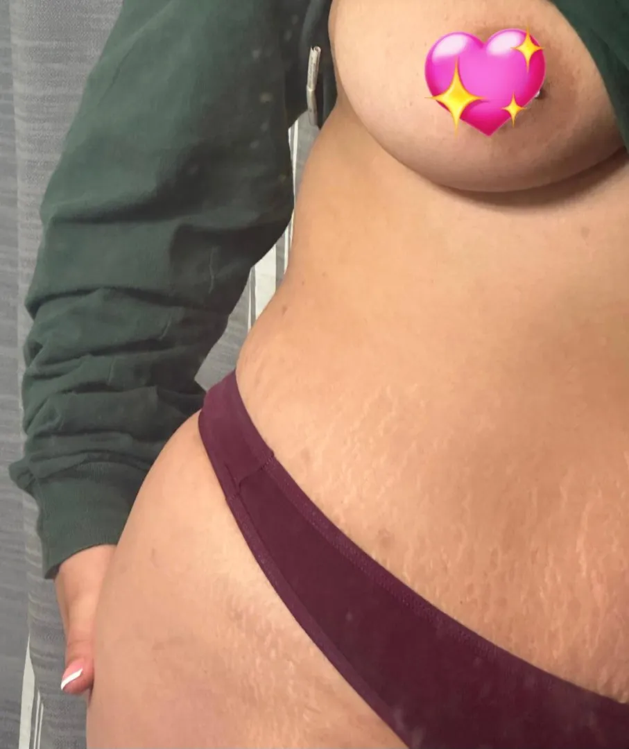 Are the stretch marks okay?
