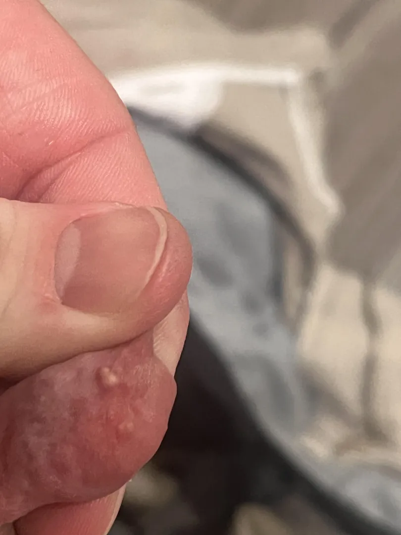 WARNING. It’s a thing on my dick. Be warned. 32M. Has lingered a couple months.