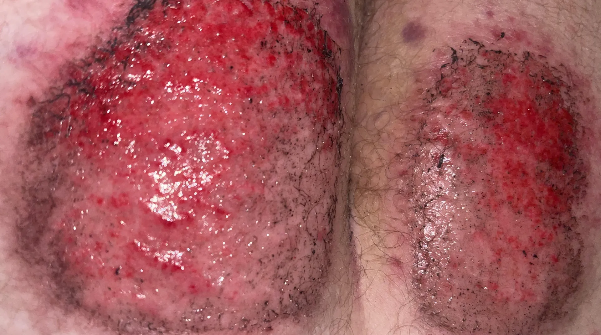 3rd degree burns, MotorCycle Accident