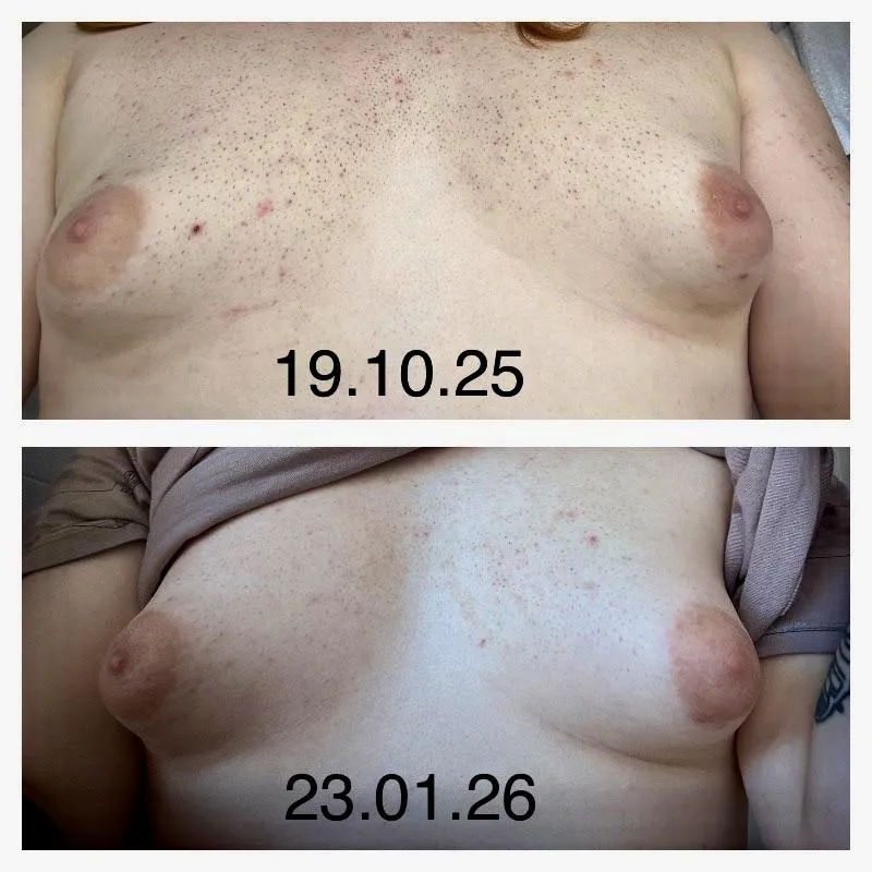 HRT Update: 6 Months In