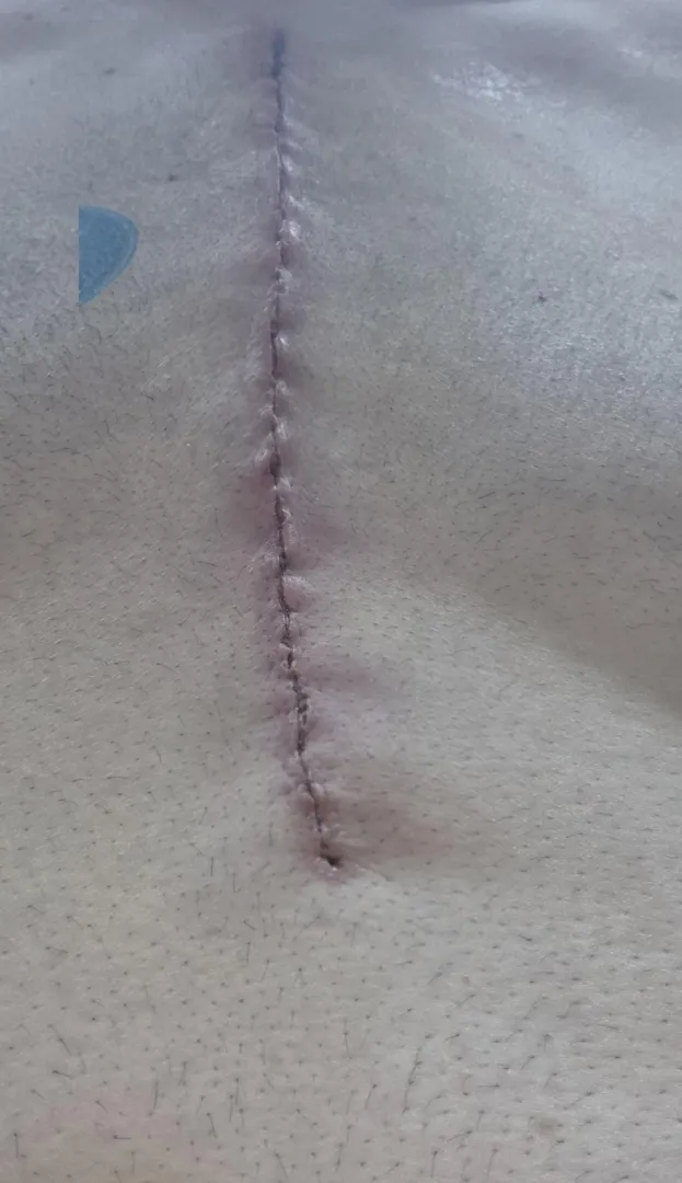 Surgical scar