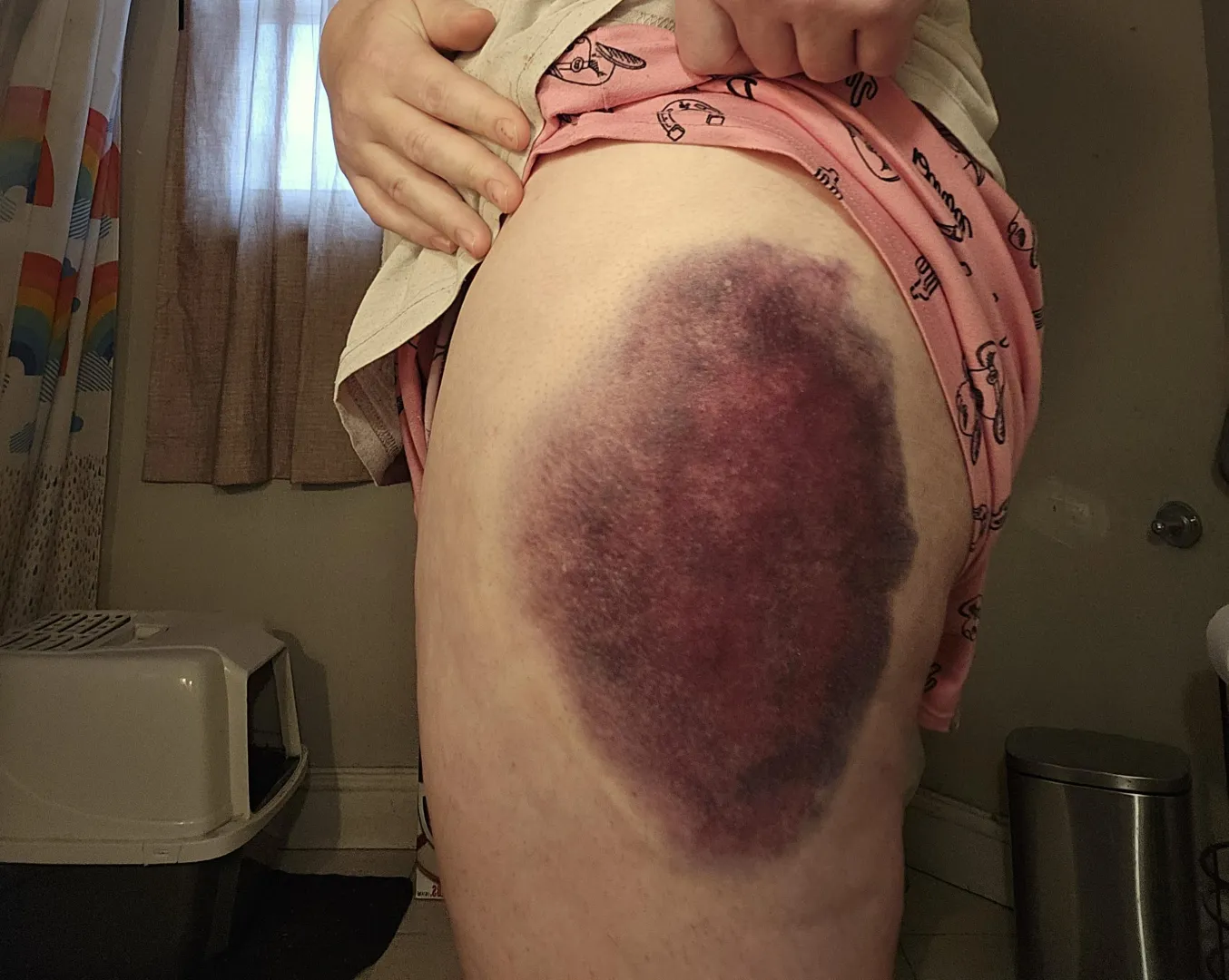 Fell on ice and hit the curb