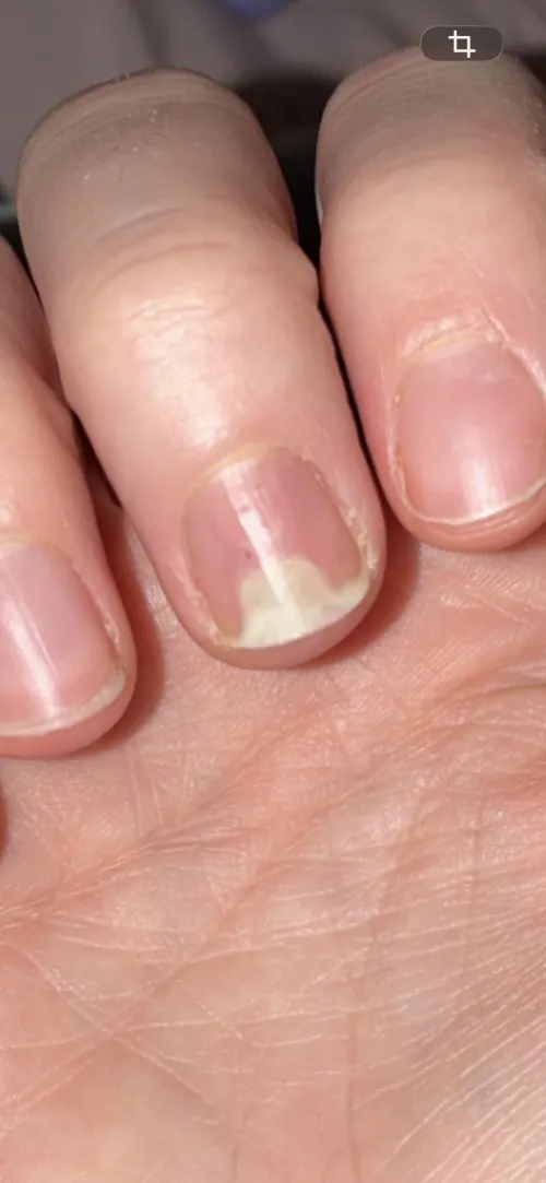 I got bit by a dog 8 months ago and my finger nail grows like this