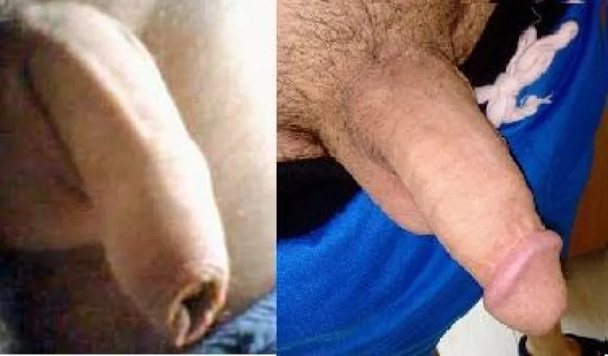 Today  I have anniversary -17 years been circumcised!