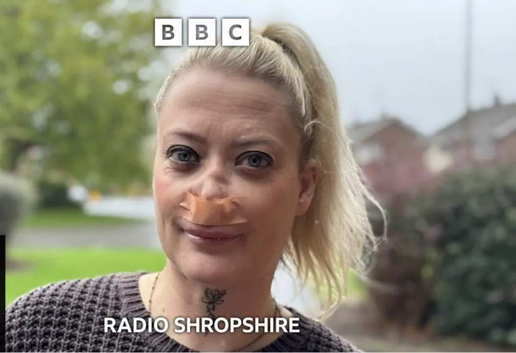 Her “Turkey Teeth” caused her nose to collapse.